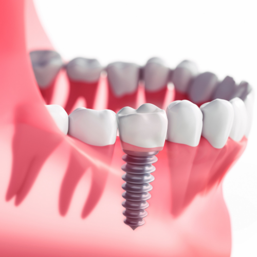 Dantų implantacija png